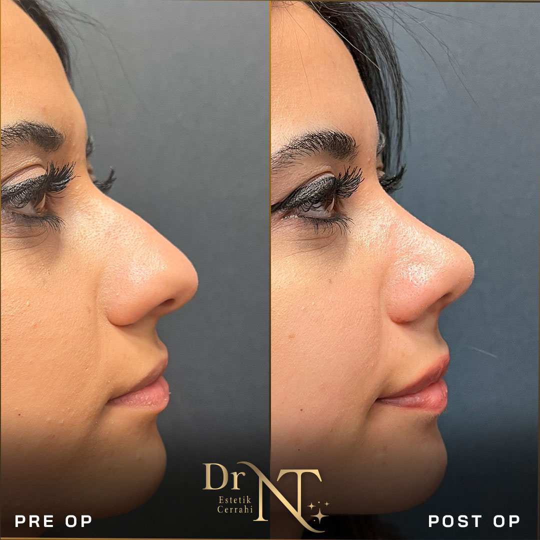 Rhinoplasty Gallery