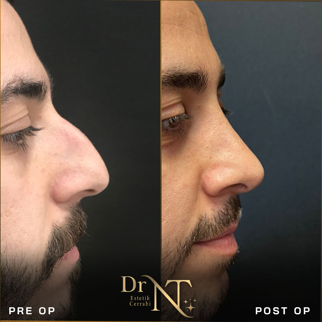 Rhinoplasty Gallery