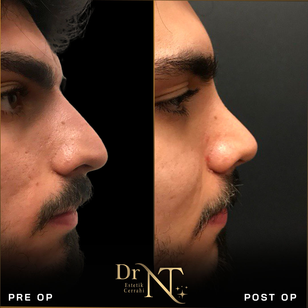 Rhinoplasty Gallery