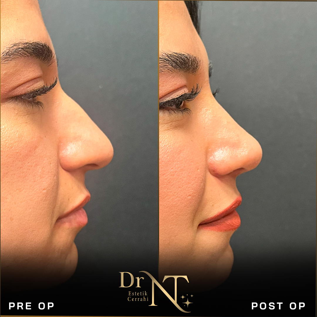 Rhinoplasty Gallery