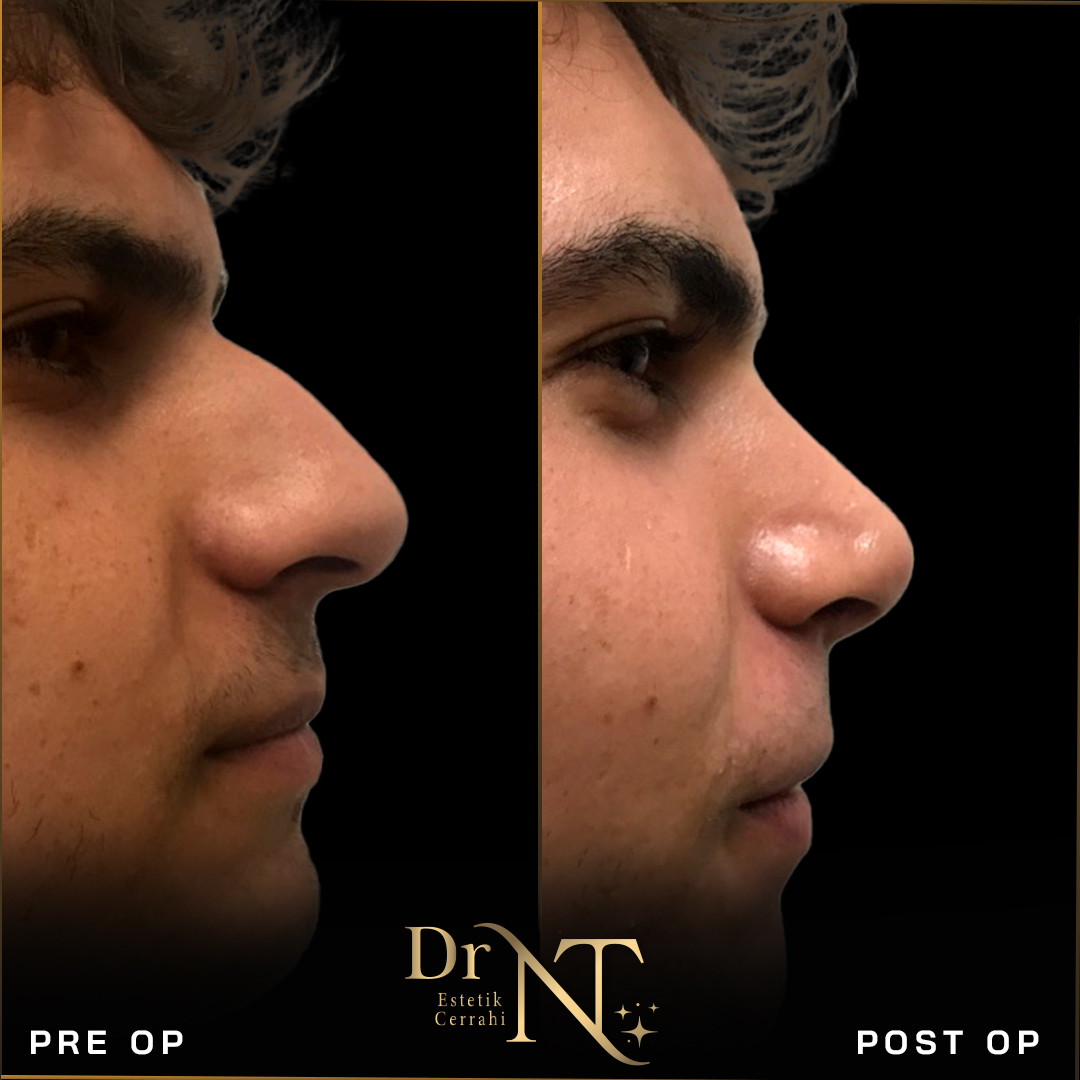 Rhinoplasty Gallery